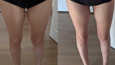 Non invasive lipo on the inner thighs from Holistic Aesthetics in Rugby